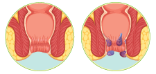 Anorectal Disorders