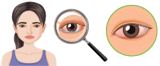 Eye Disorders