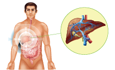 Liver Disorders