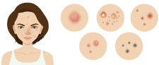 Skin Disorders